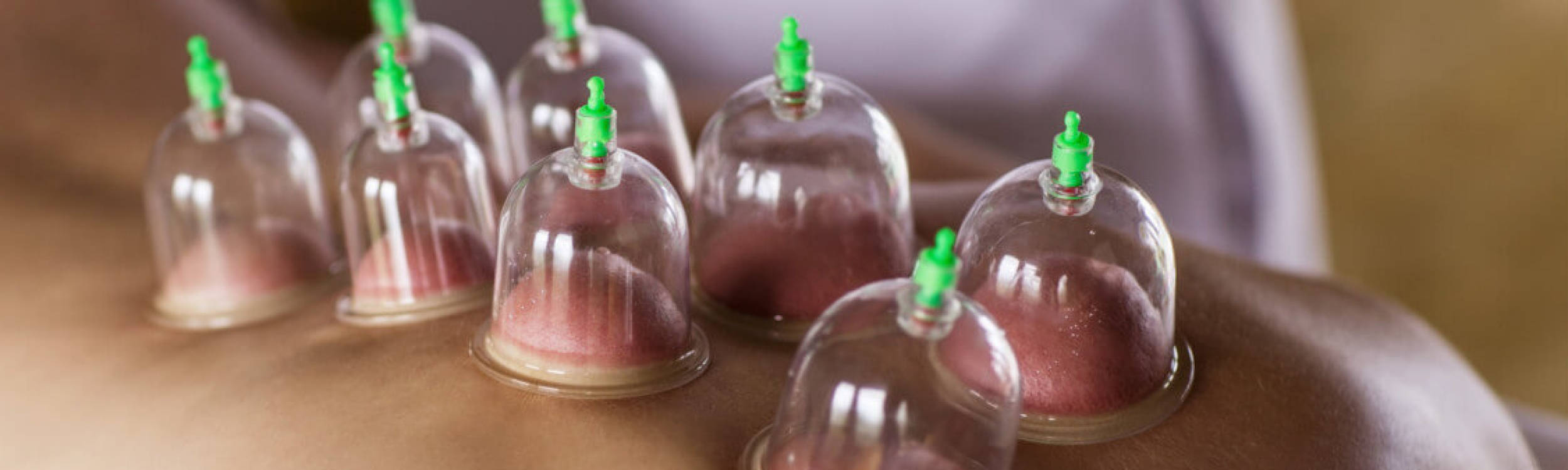 Cupping Therapy for Myofascial Release